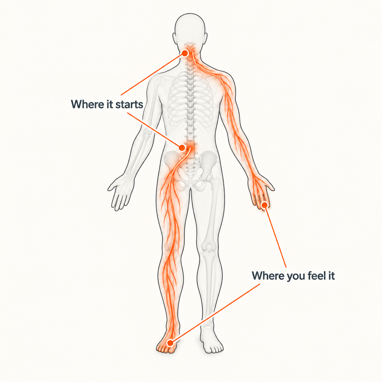 Infographic showing how a pinched nerve in the neck causes symptoms in the arm and hand and a pinched nerve in the low back causes symptoms in the leg and foot