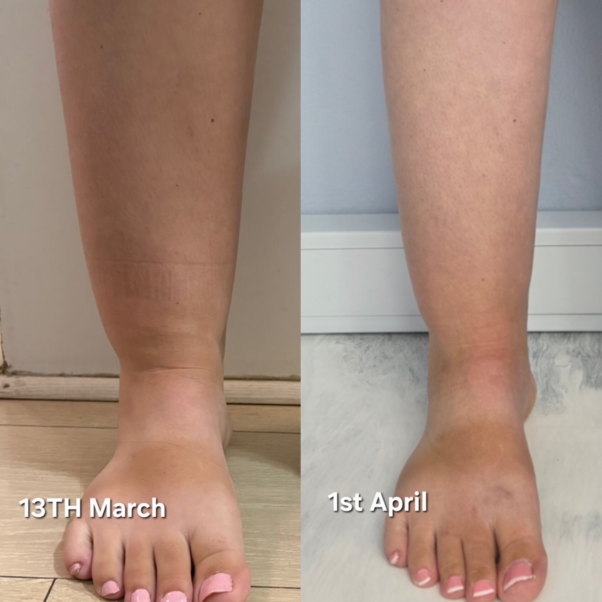 results in the legs