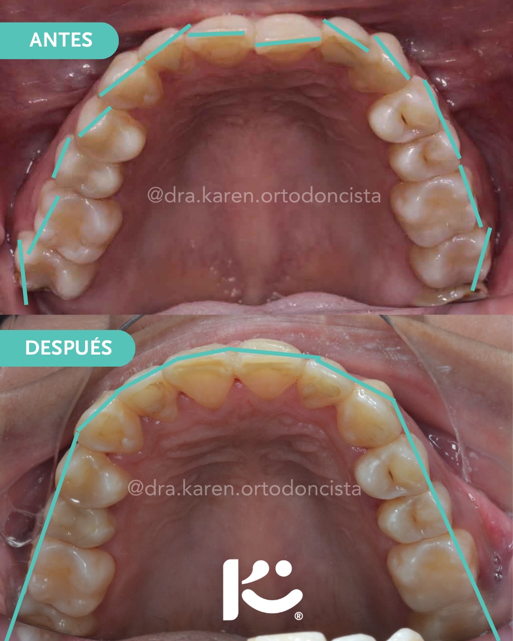 Antes y después — caso 6