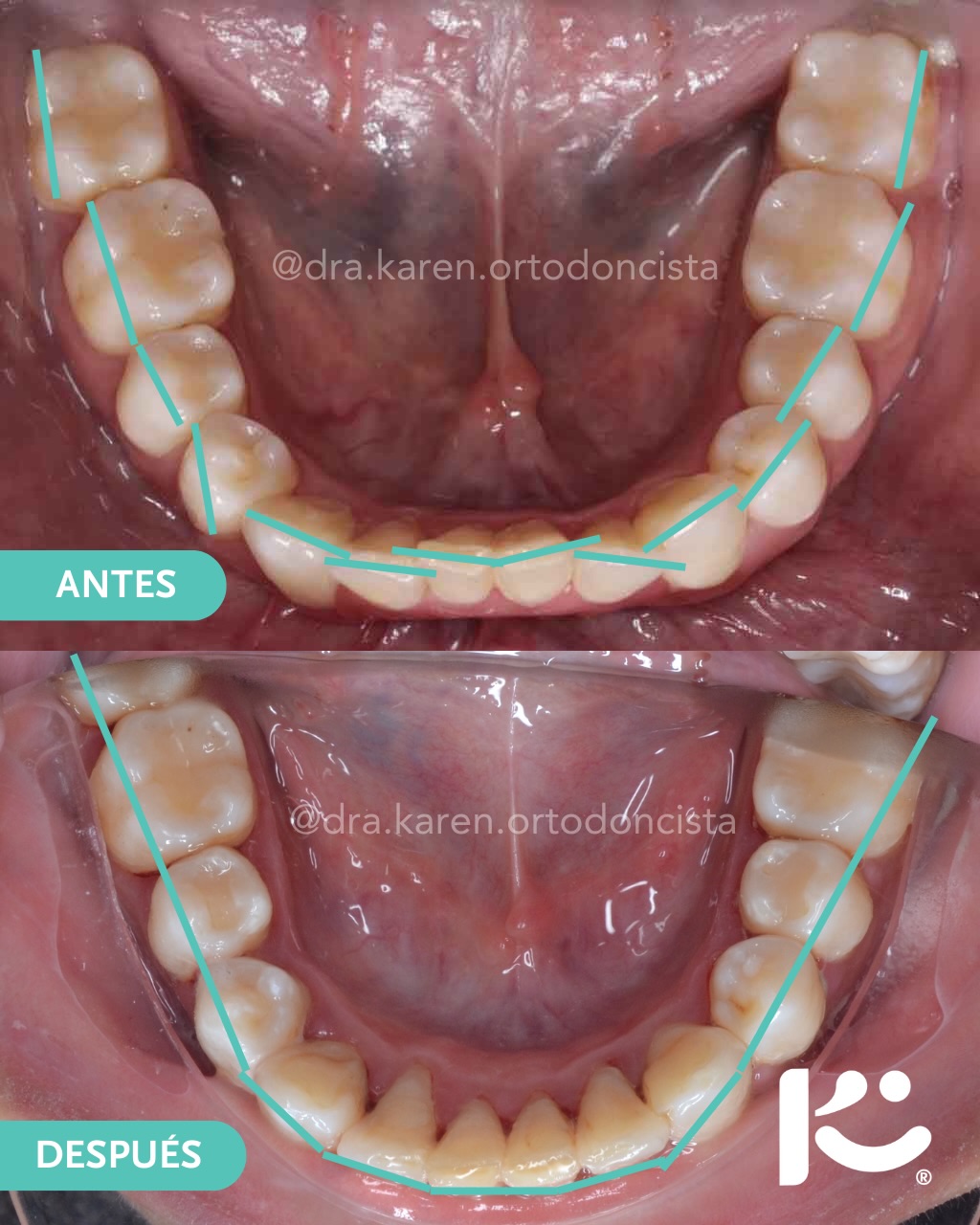 Antes y después — caso 10