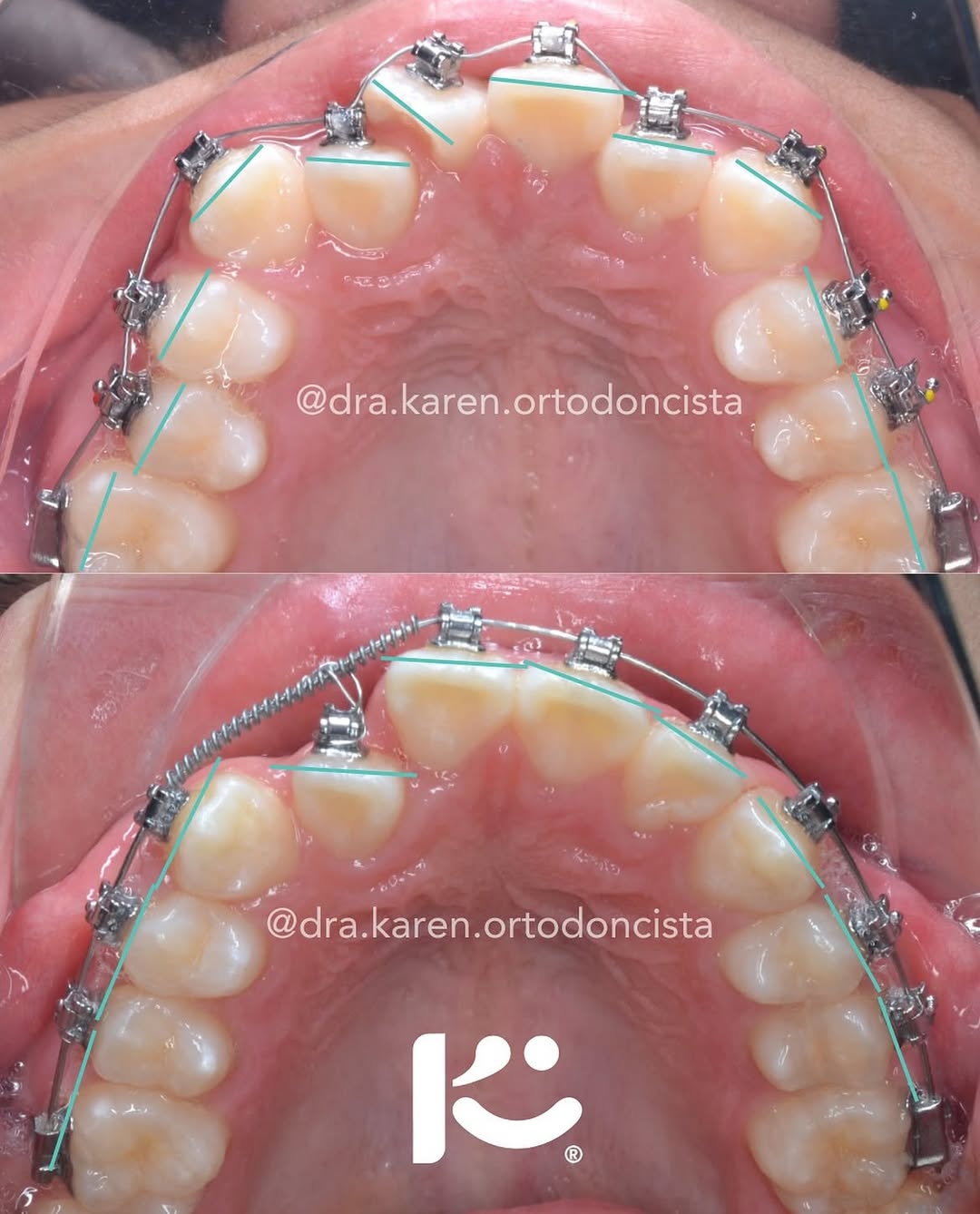 Antes y después — caso 5