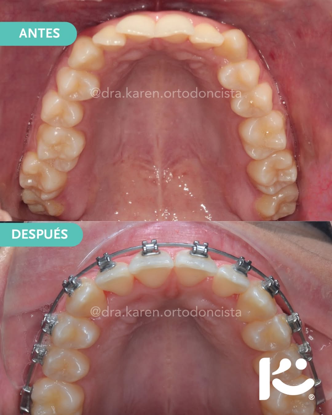 Antes y después — caso 1