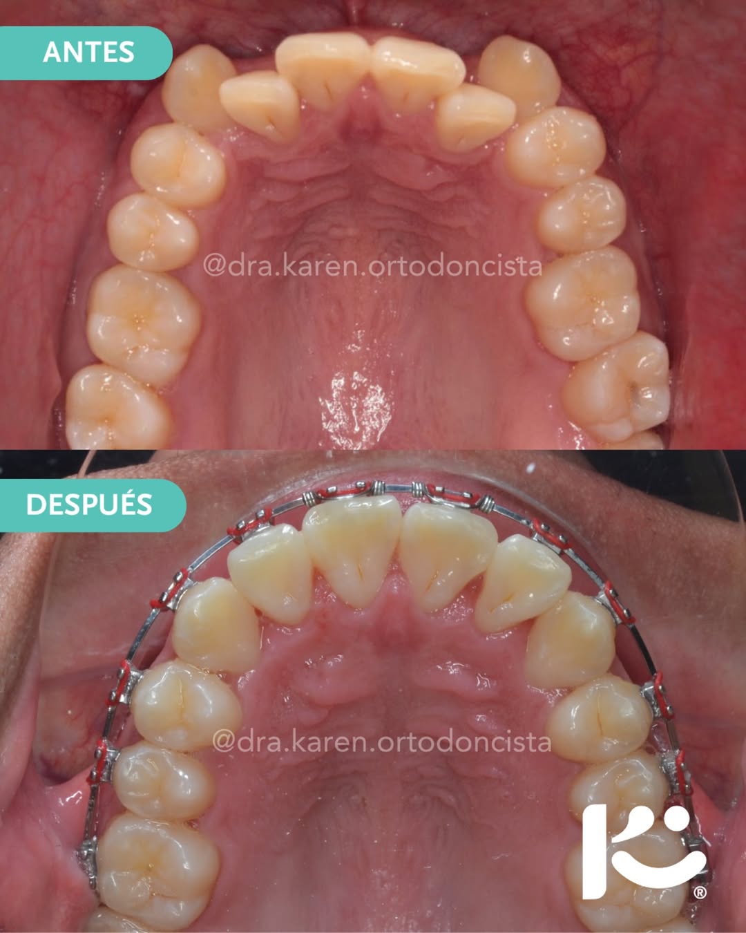 Antes y después — caso 3
