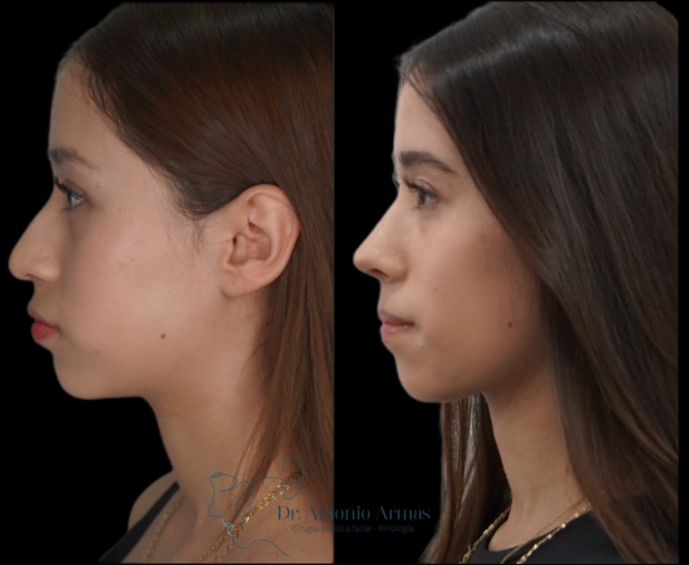 Rinoplastia ultrasónica Dr. Antonio Armas