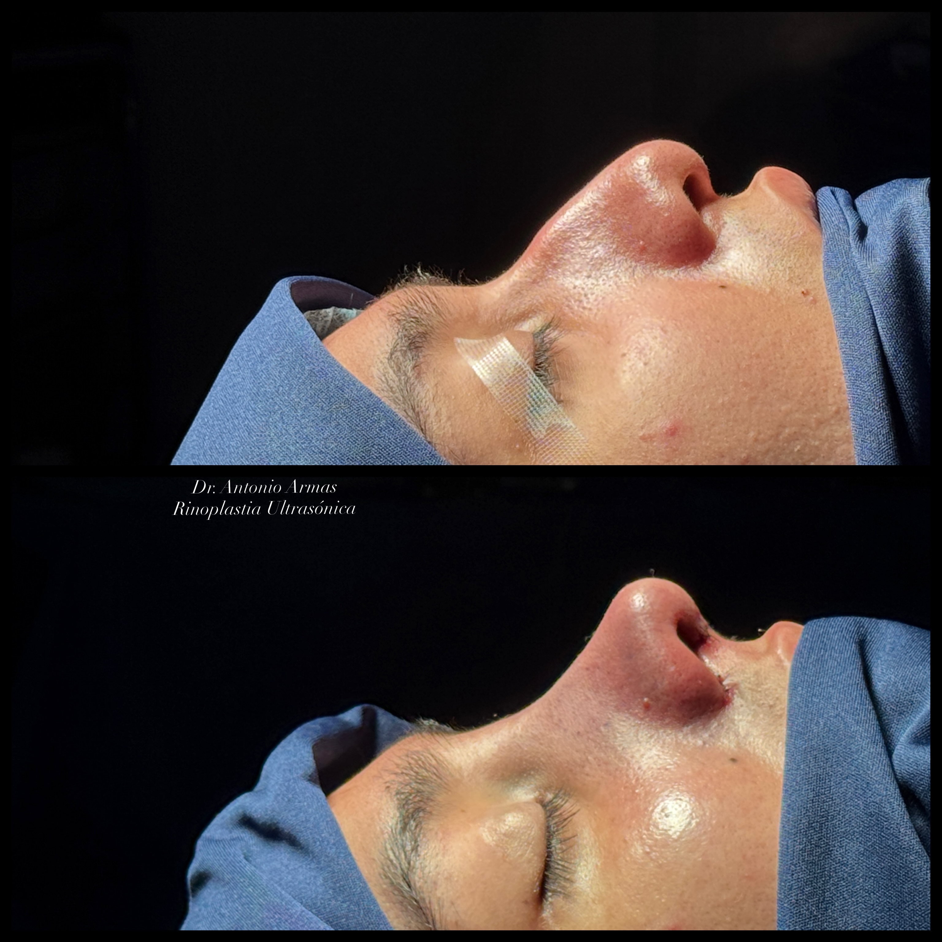 Caso de éxito 6 rinoplastia ultrasónica Dr. Antonio Armas