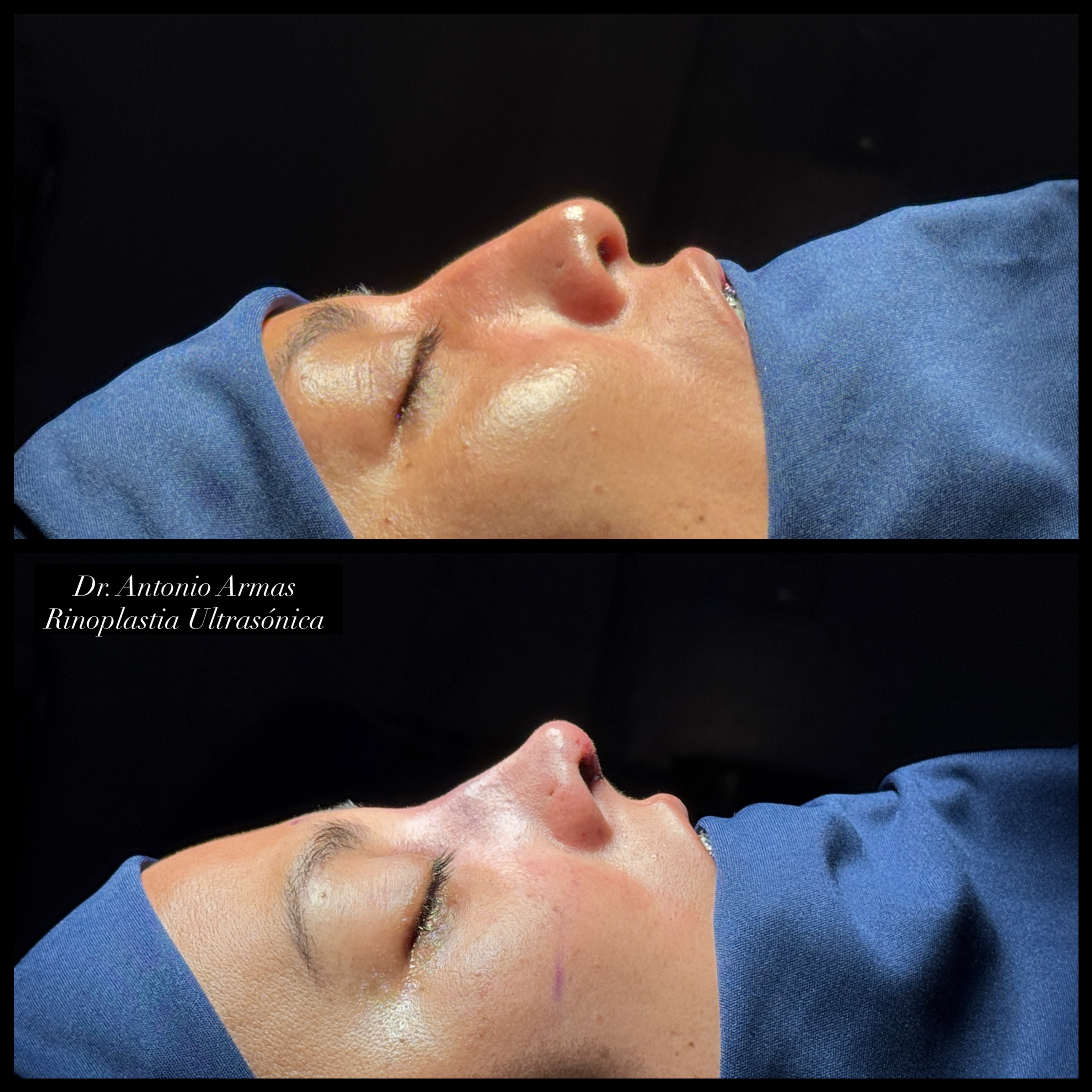 Caso de éxito 5 rinoplastia ultrasónica Dr. Antonio Armas