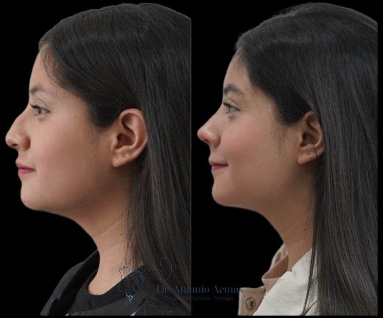 Caso de éxito 4 rinoplastia ultrasónica Dr. Antonio Armas