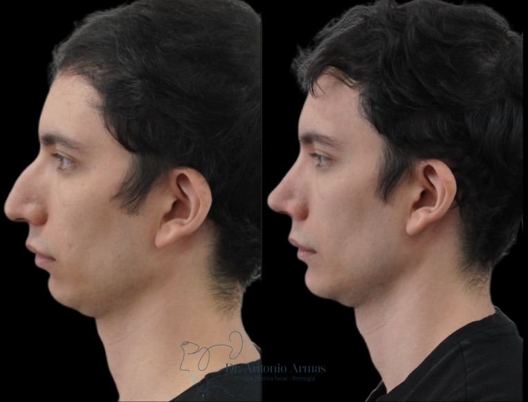 Caso de éxito 3 rinoplastia ultrasónica Dr. Antonio Armas