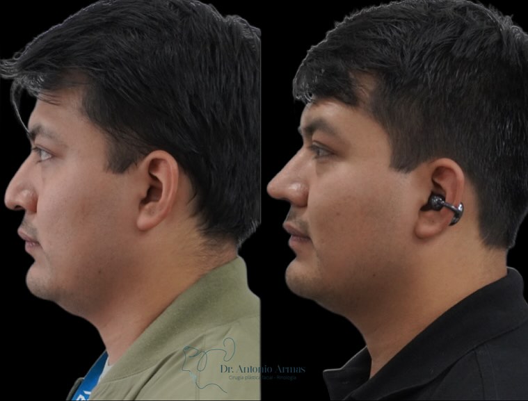 Caso de éxito 2 rinoplastia ultrasónica Dr. Antonio Armas