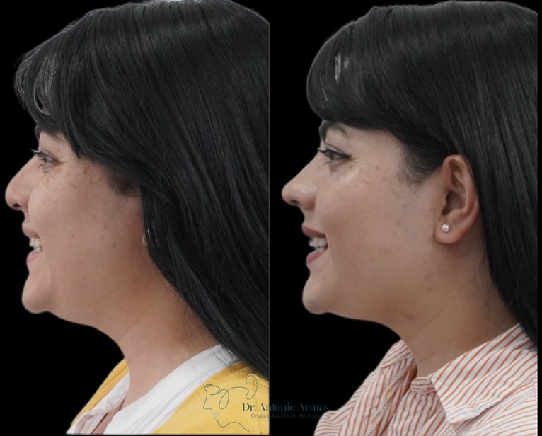 Caso de éxito 1 rinoplastia ultrasónica Dr. Antonio Armas