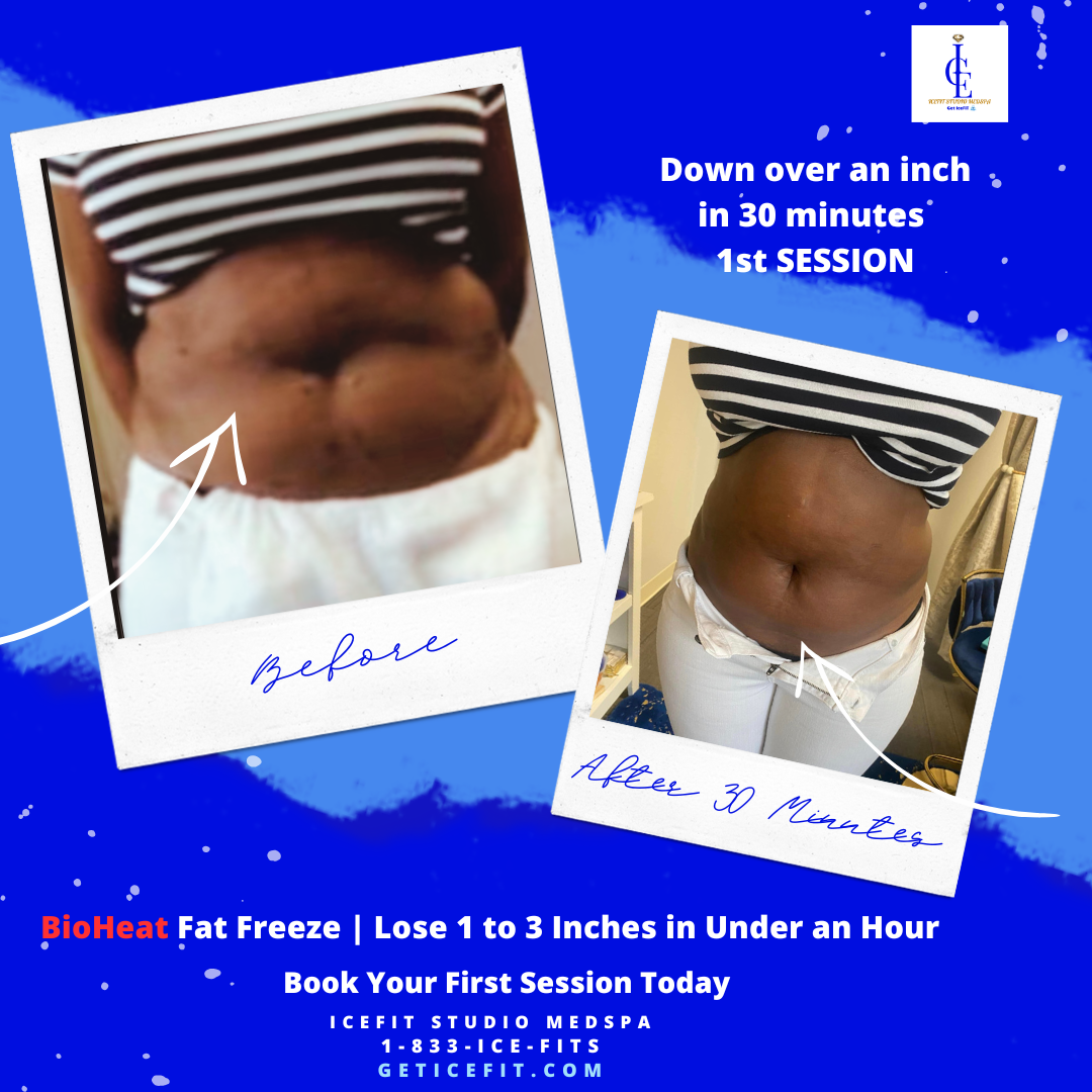 BioFat Freeze before and after abdomen, down over an inch in one session