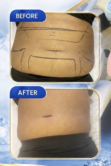 BioFat Freeze before and after abdomen with treatment mapping, one session