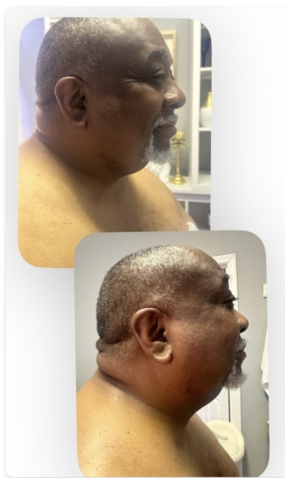 BioFat Freeze before and after, jaw and neck, one session