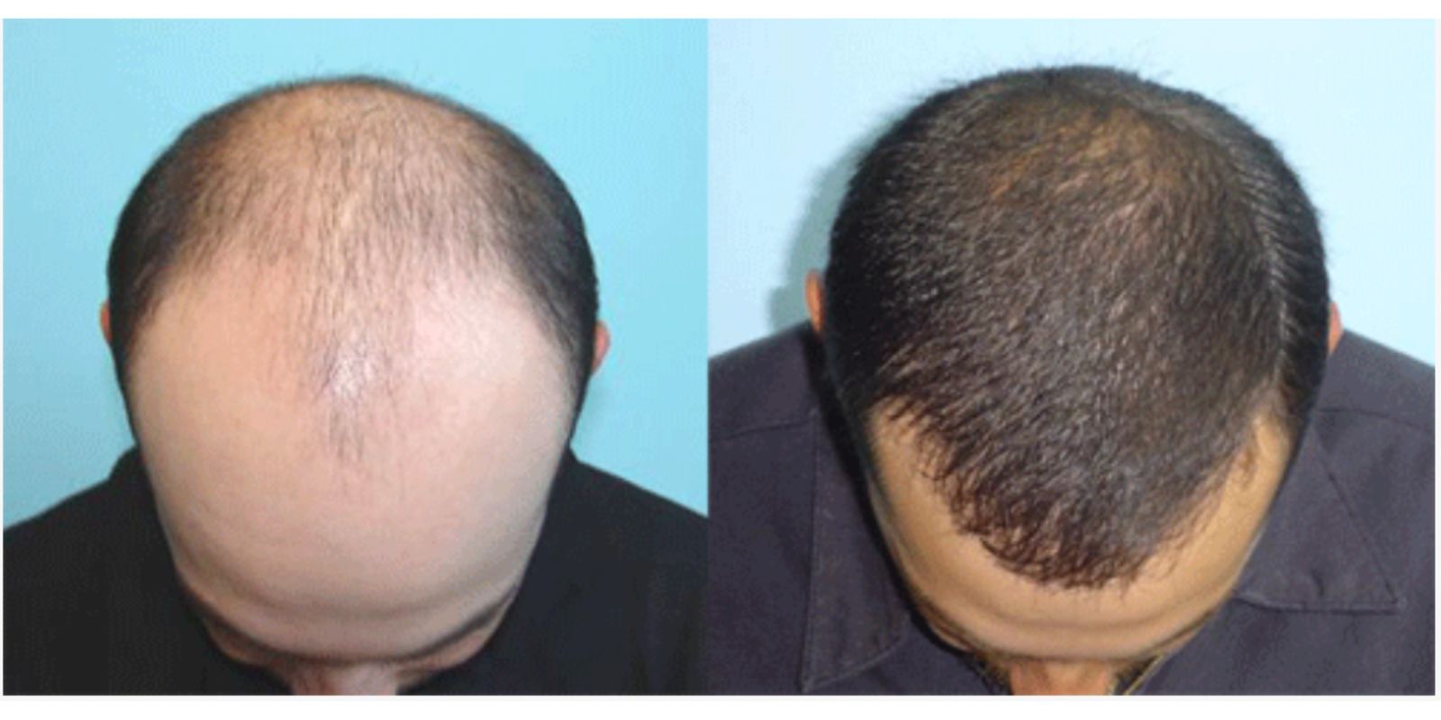Representative case — before and after hair restoration