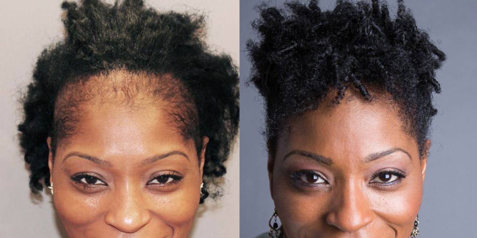 Representative case — before and after hair restoration