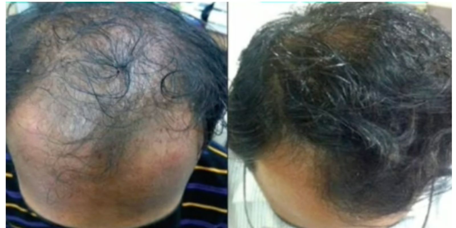 Representative case — before and after hair restoration