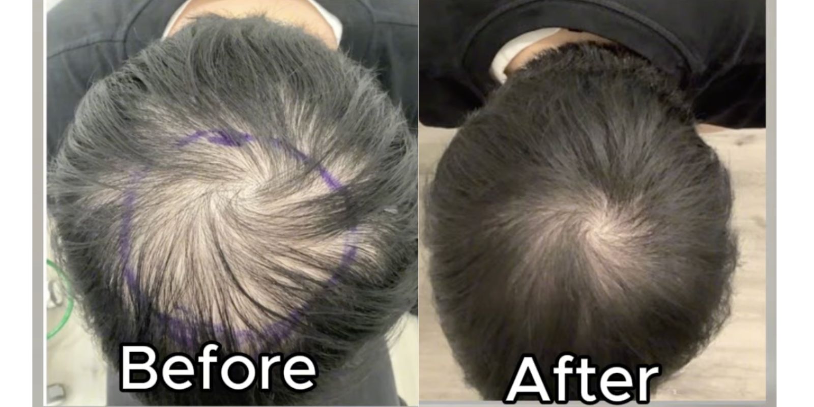 Representative case — before and after dermal papilla exosome hair restoration