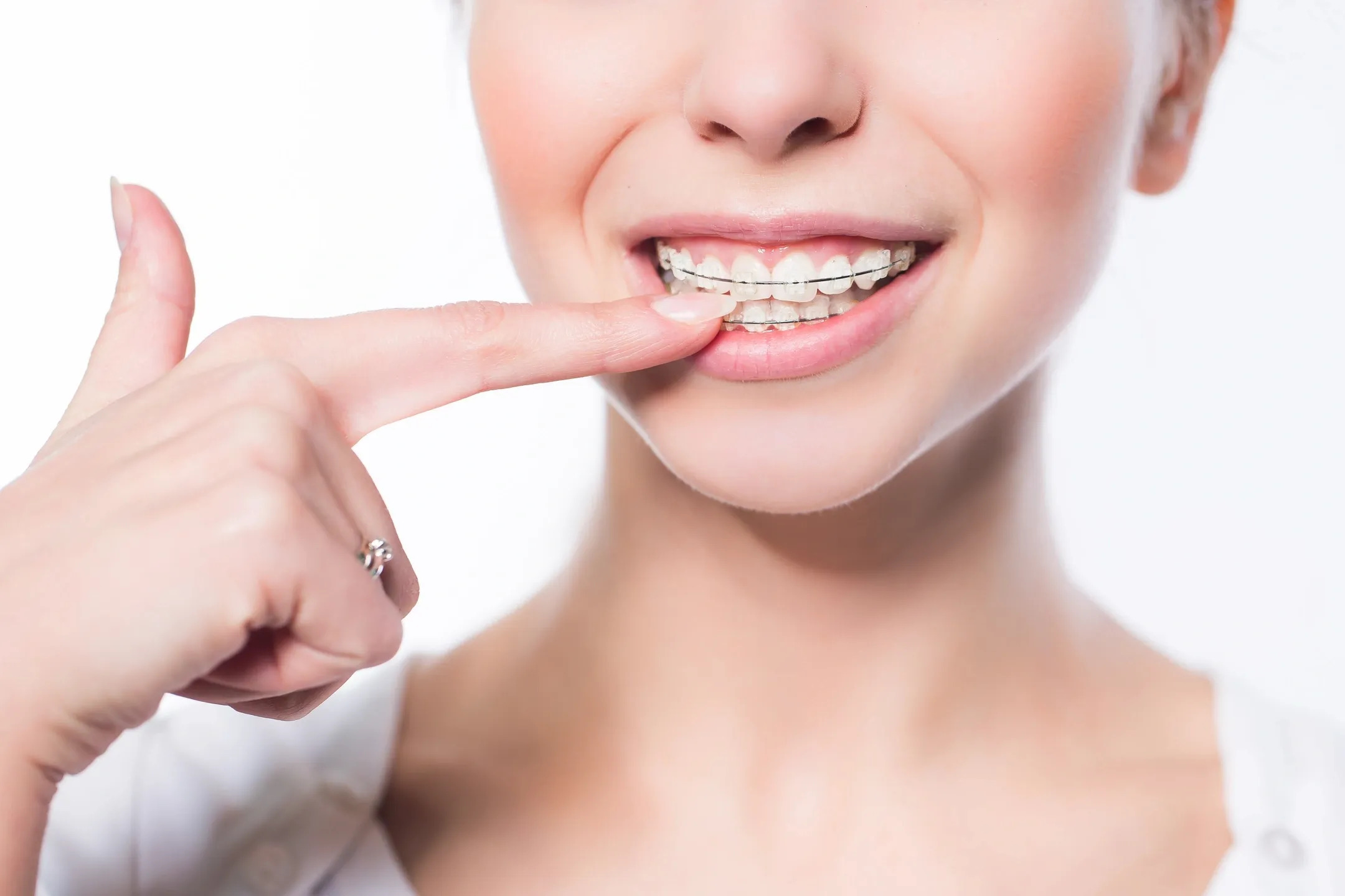 Patient with clear ceramic braces