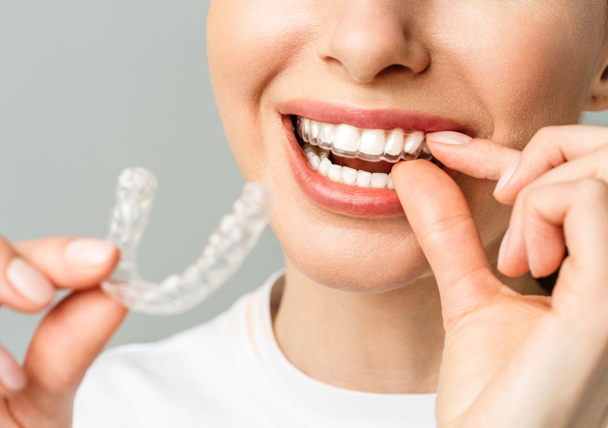 Patient wearing Invisalign clear aligners