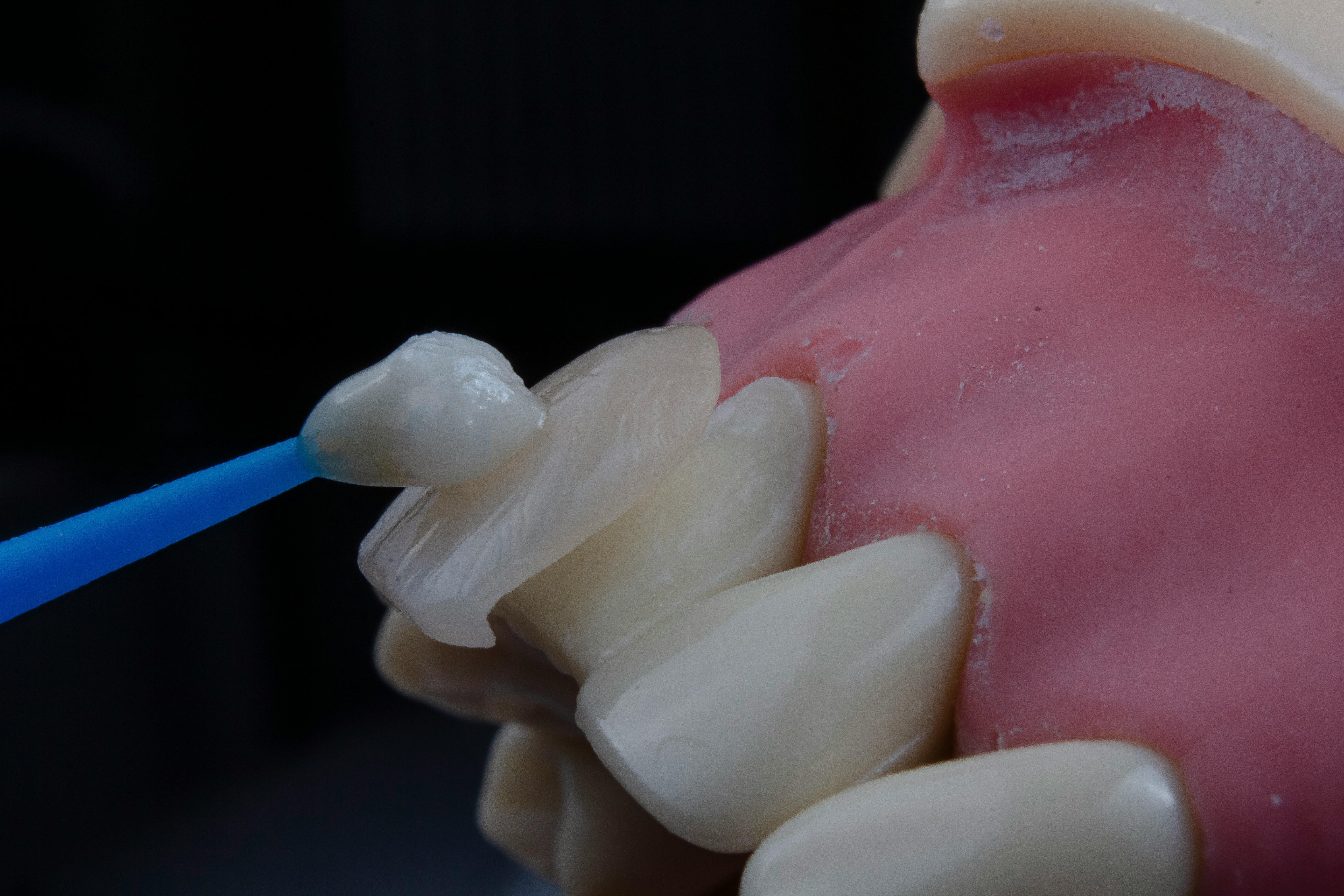 Composite Bonding | Restore Your Smile at Highfield Dental Practice in