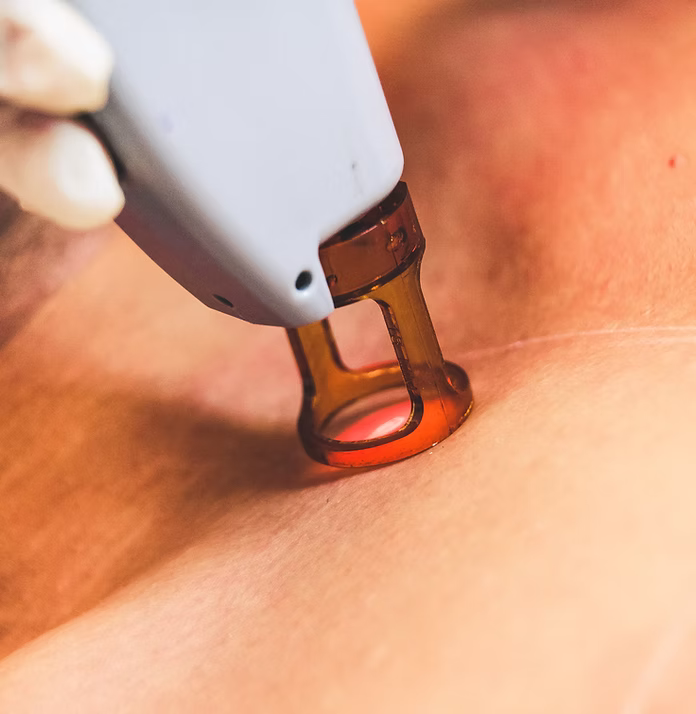 Endolaser treatment at Central Medical Center