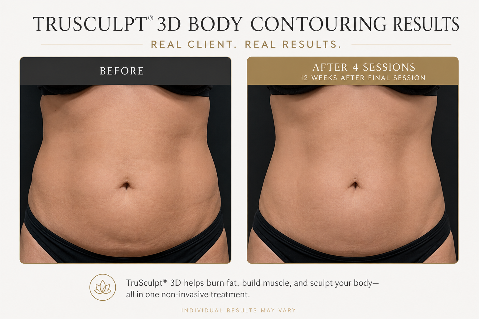 Illustrative body contouring before and after comparison