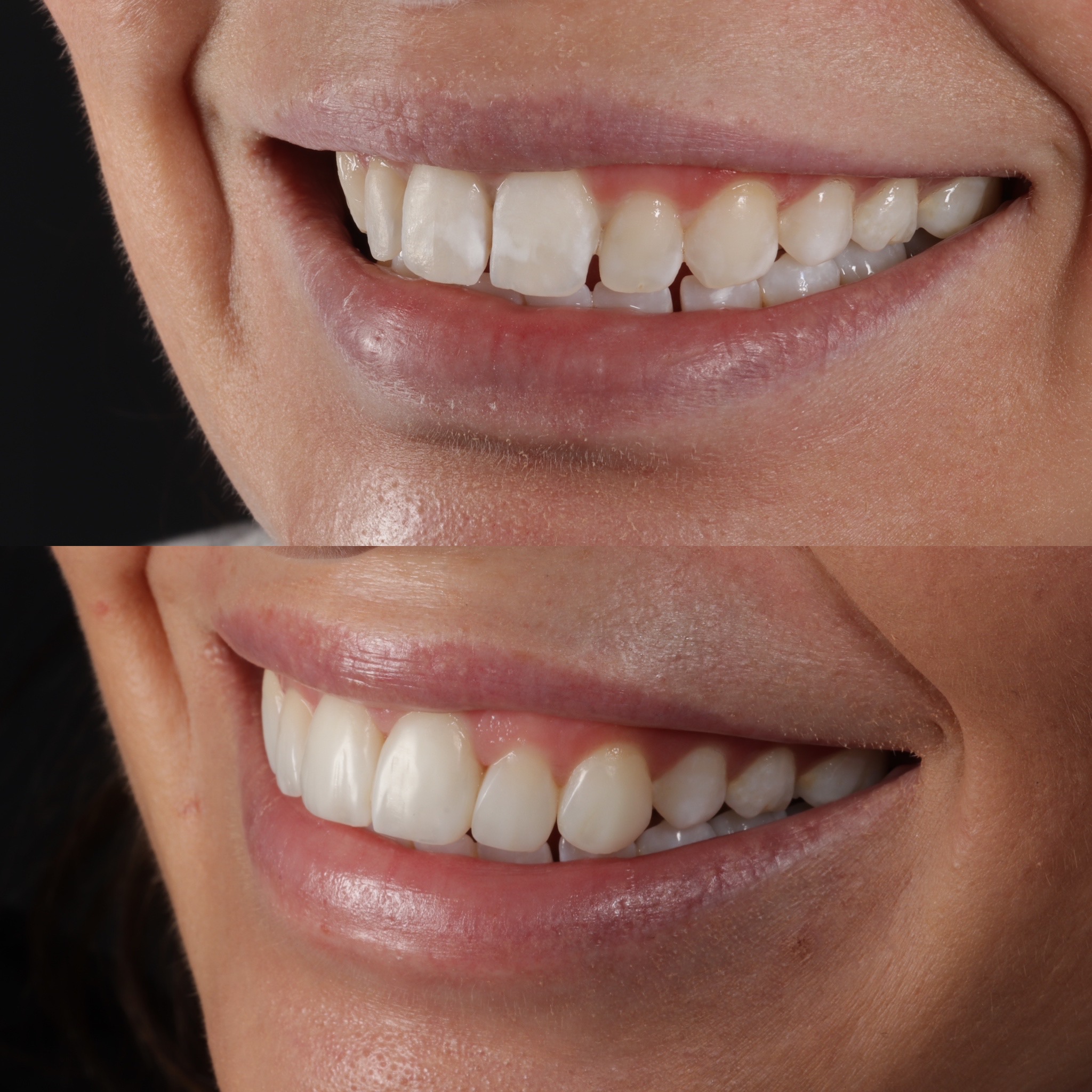 Case 19's Composite Bonding transformation