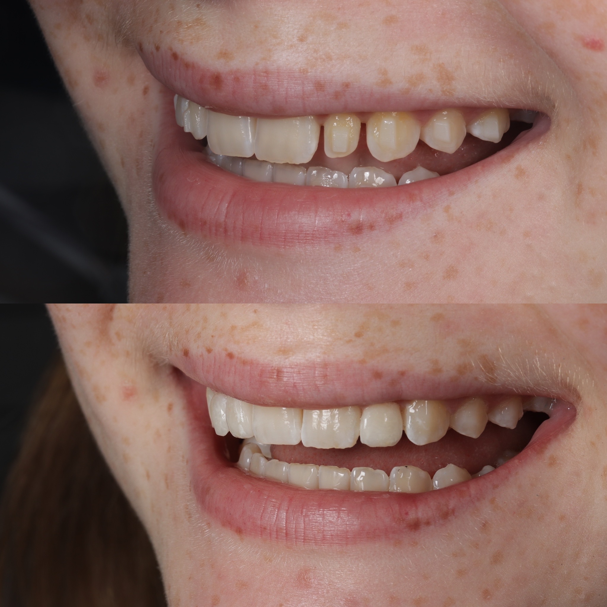 Case 18's Composite Bonding transformation