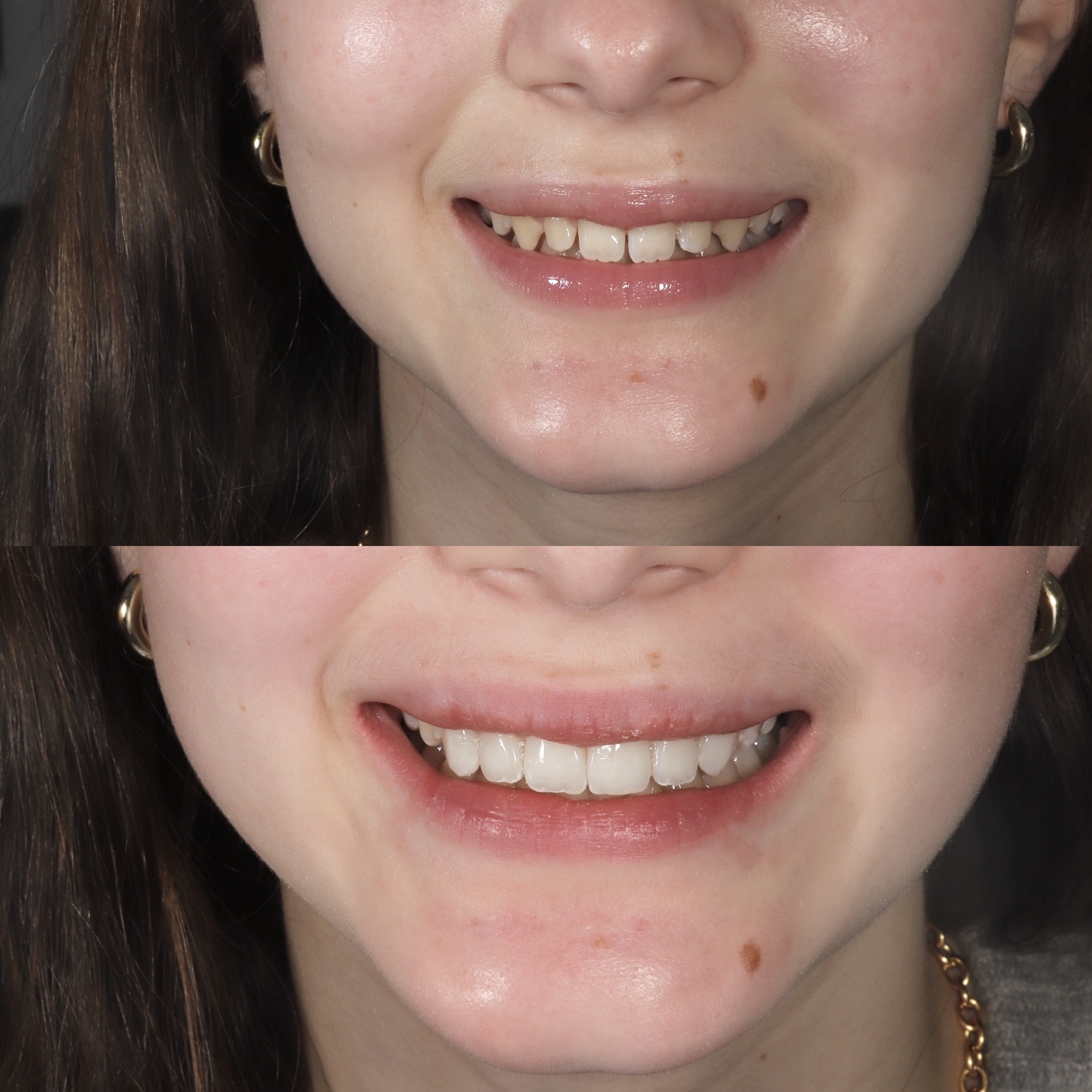 Case 20's Composite Bonding transformation