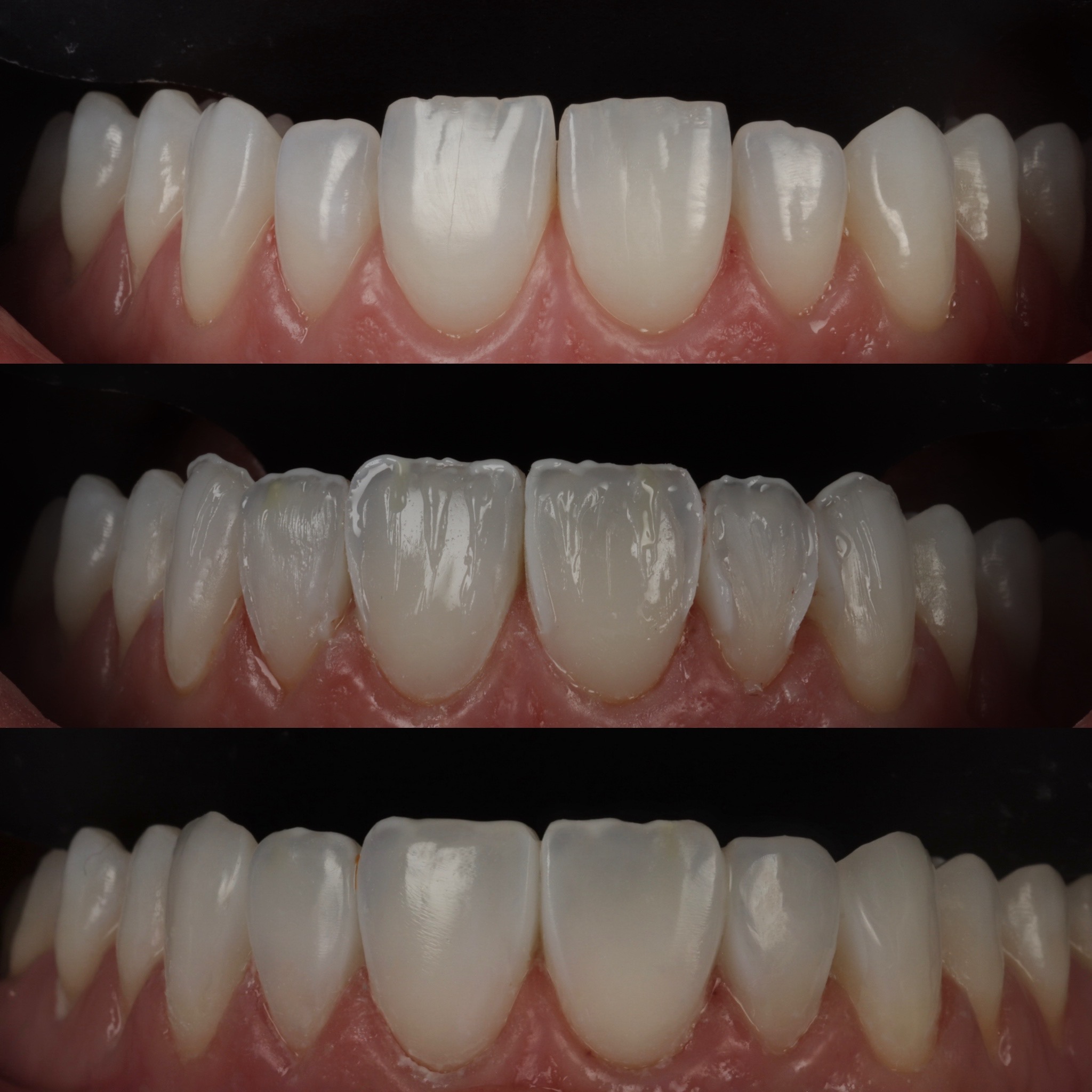Case 17's Composite Bonding transformation