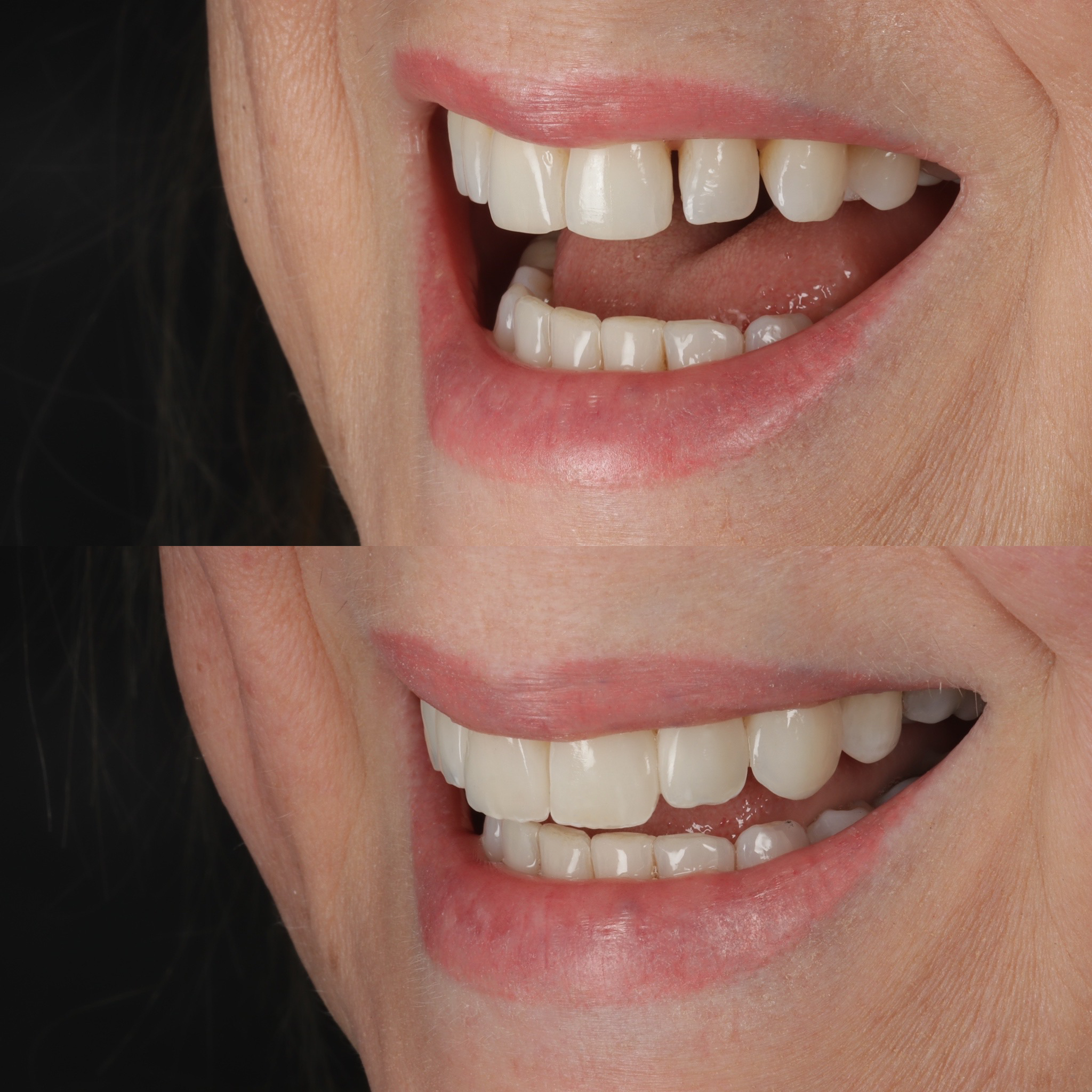 Case 11's Composite Bonding transformation