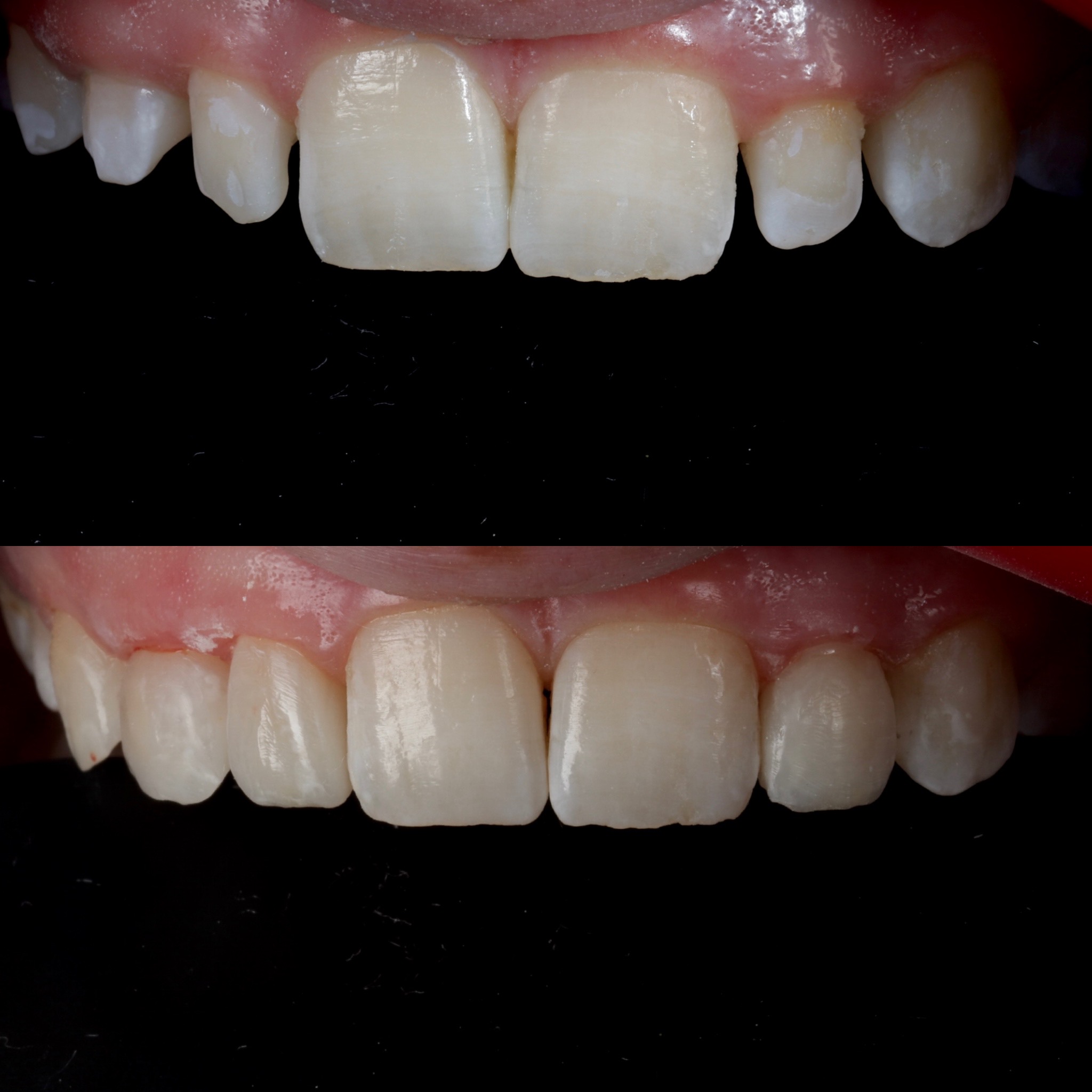 Case 16's Composite Bonding transformation