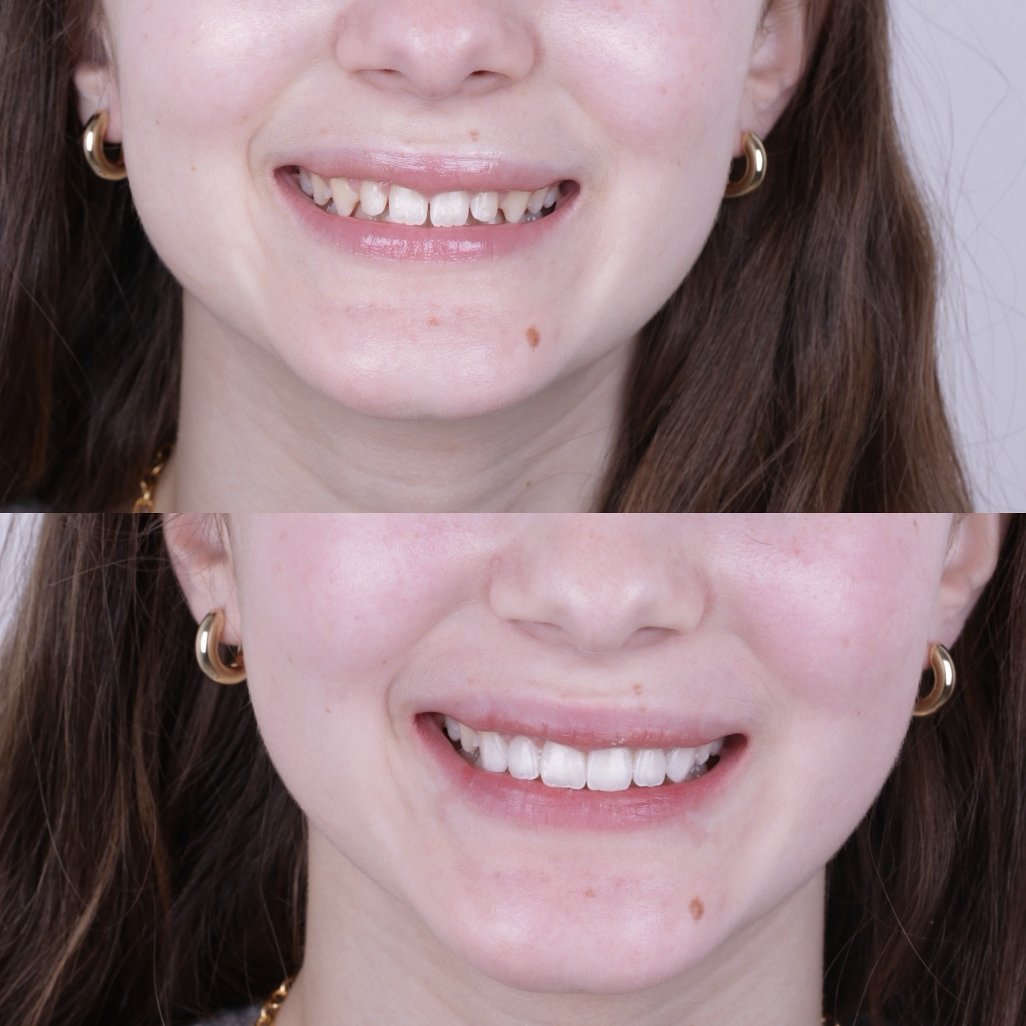 Case 6's Composite Bonding transformation