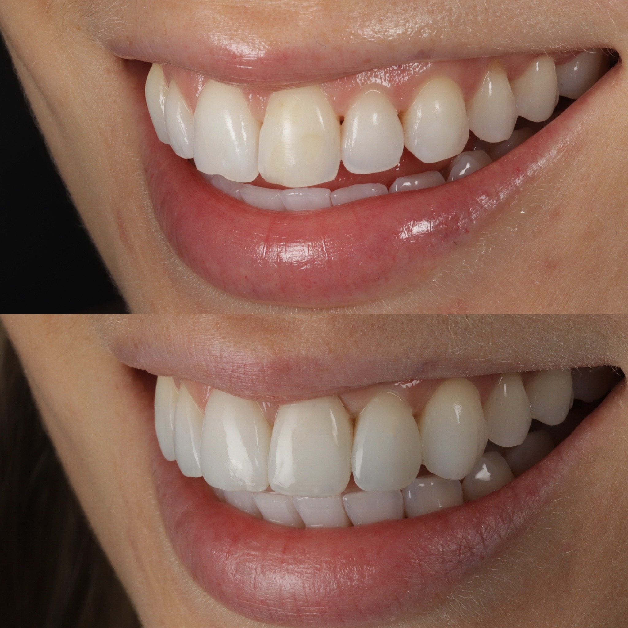Case 14's Composite Bonding transformation