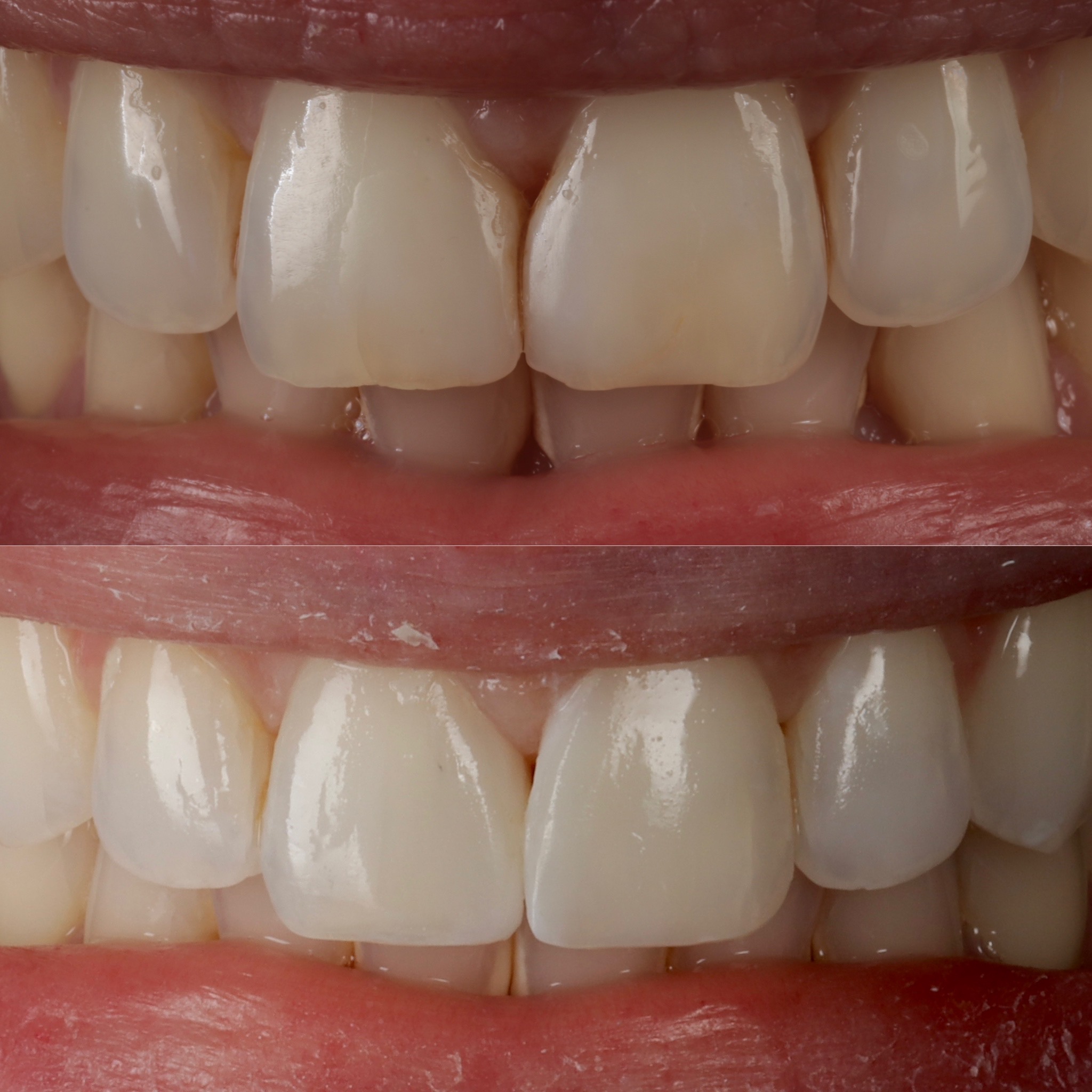Case 13's Composite Bonding transformation