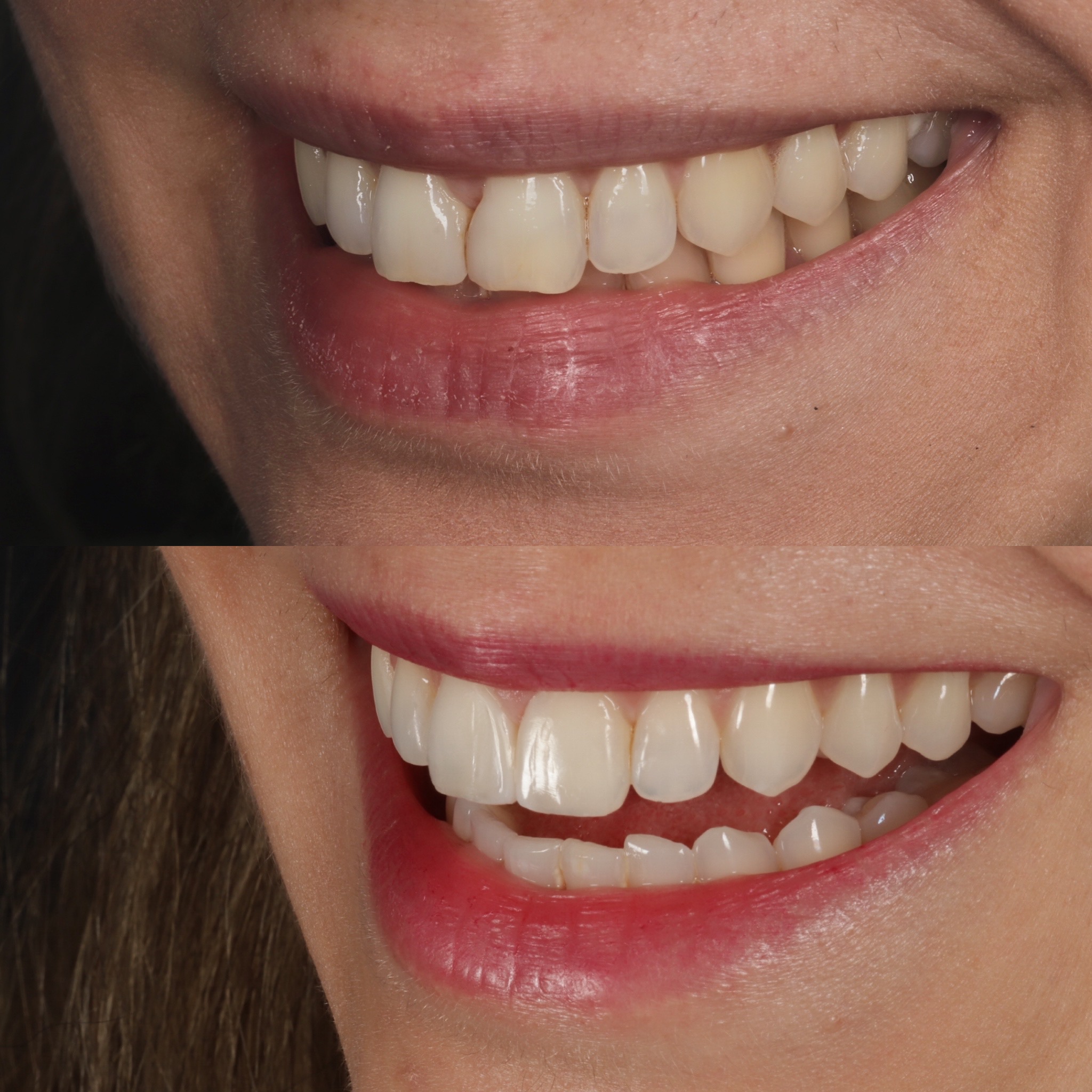 Case 12's Composite Bonding transformation