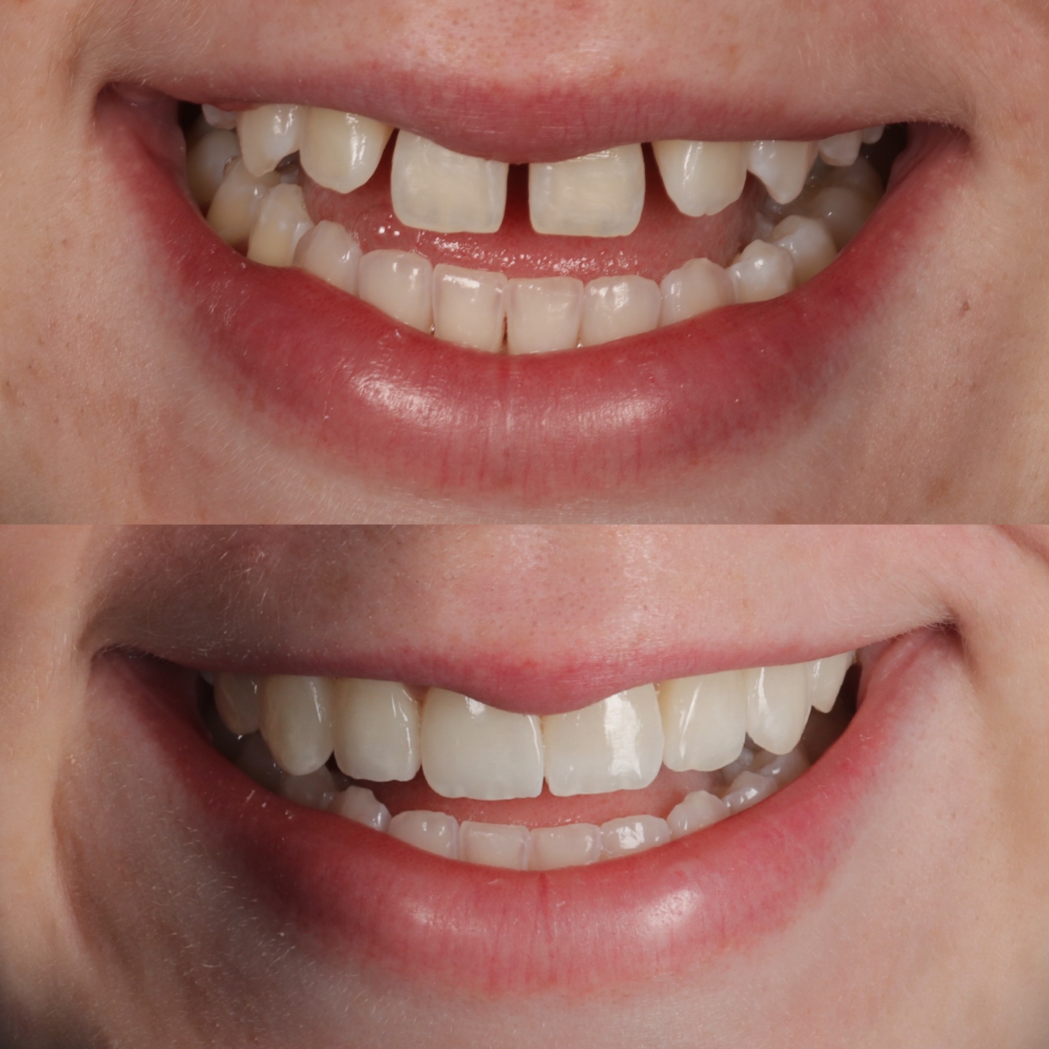 Case 10's Composite Bonding transformation