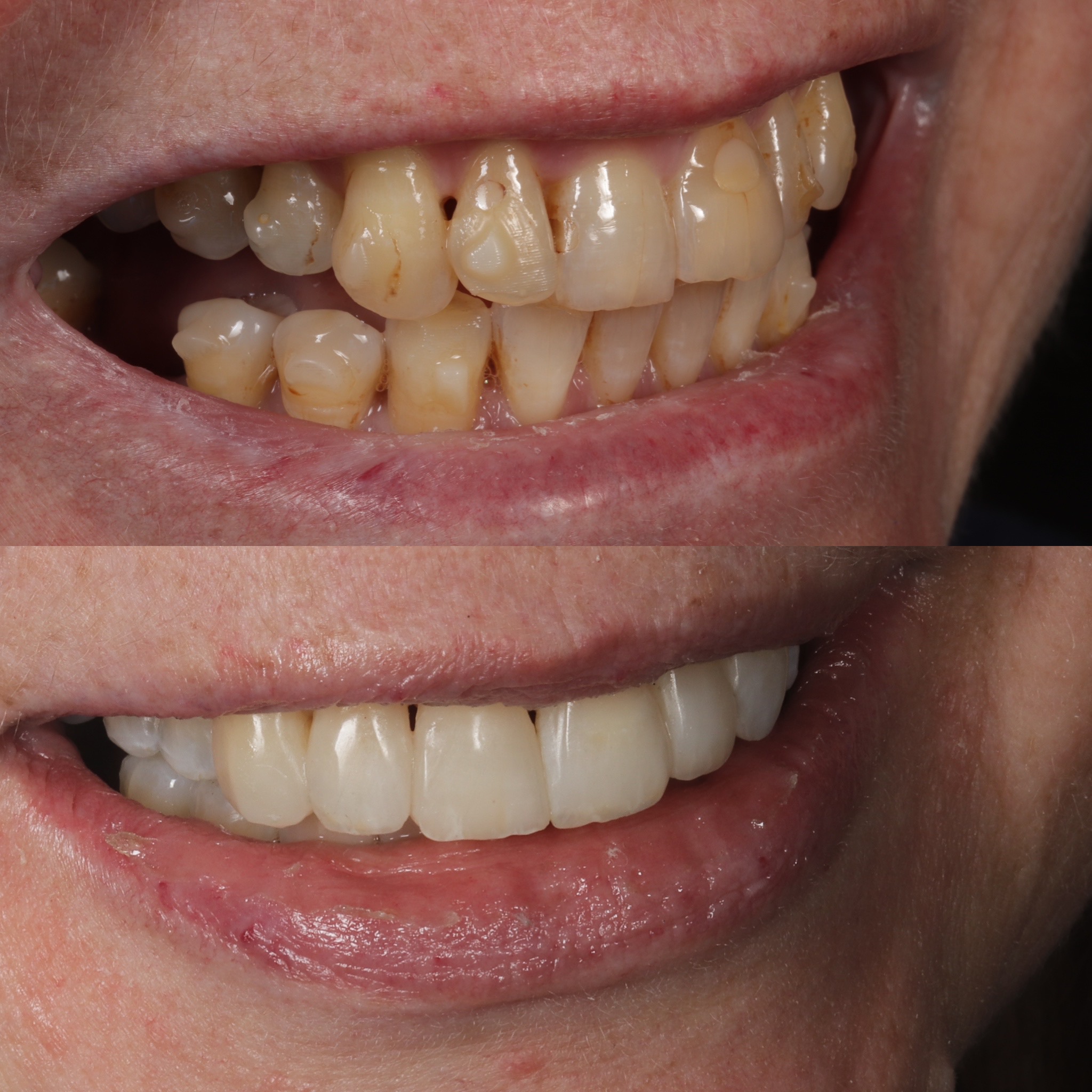 Case 9's Composite Bonding transformation