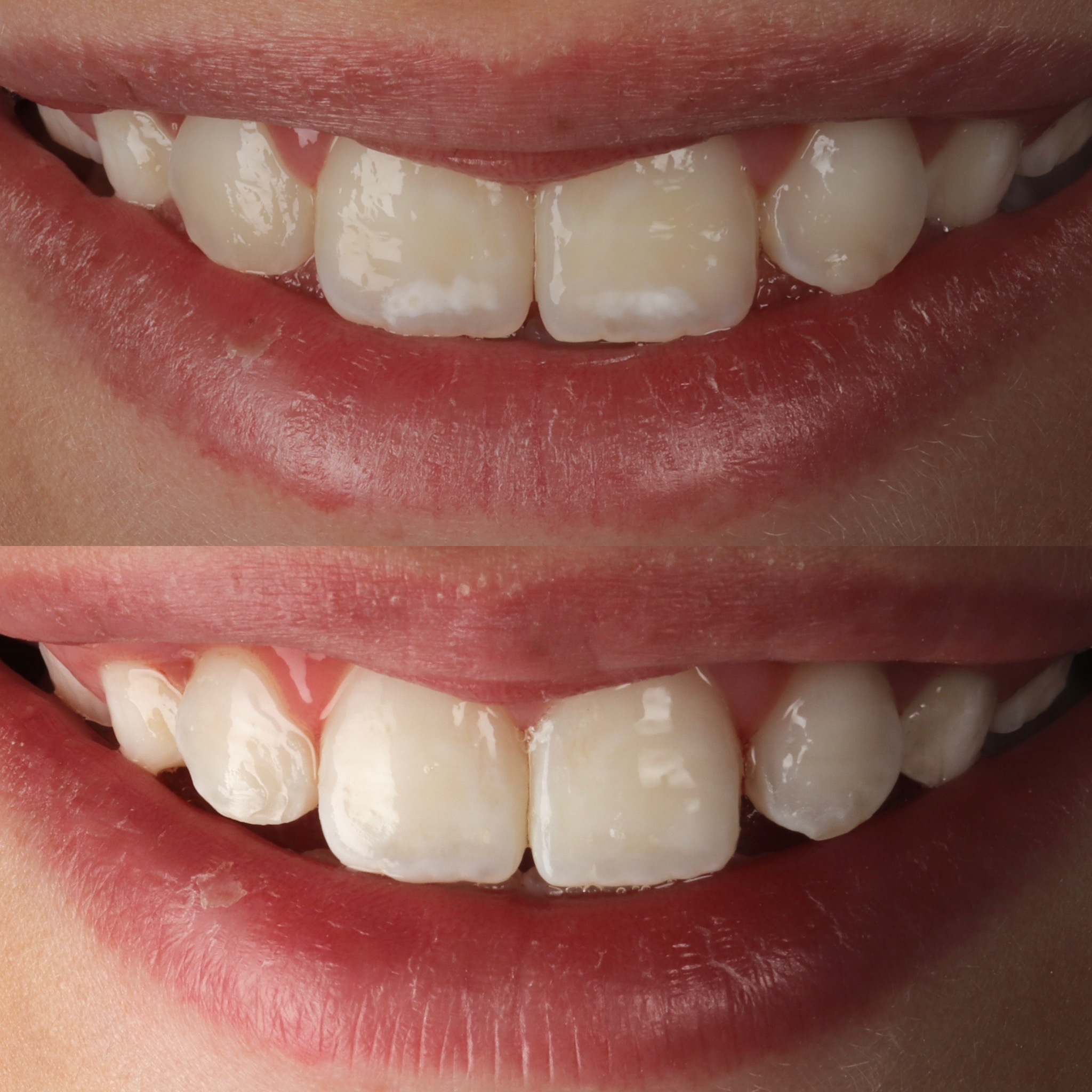 Case 8's Composite Bonding transformation