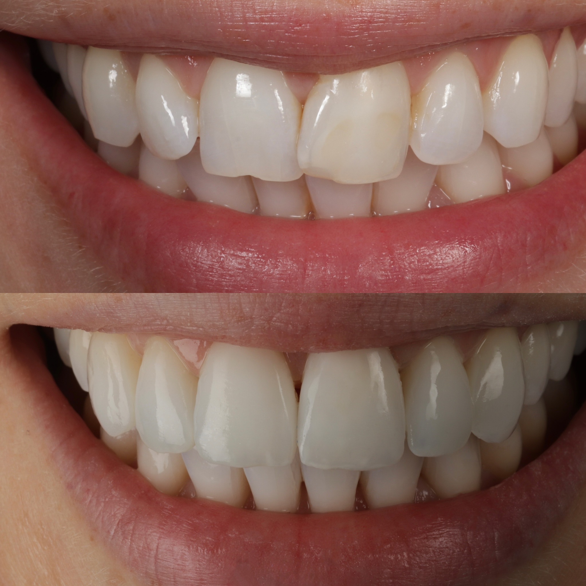 Case 7's Composite Bonding transformation