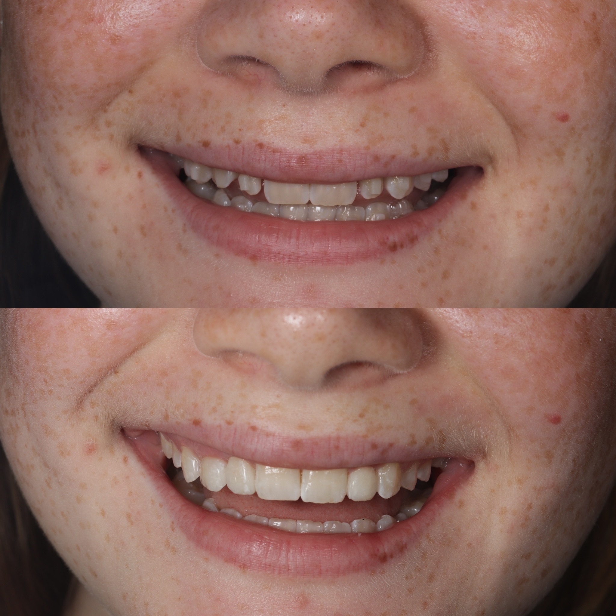Case 5's Composite Bonding transformation