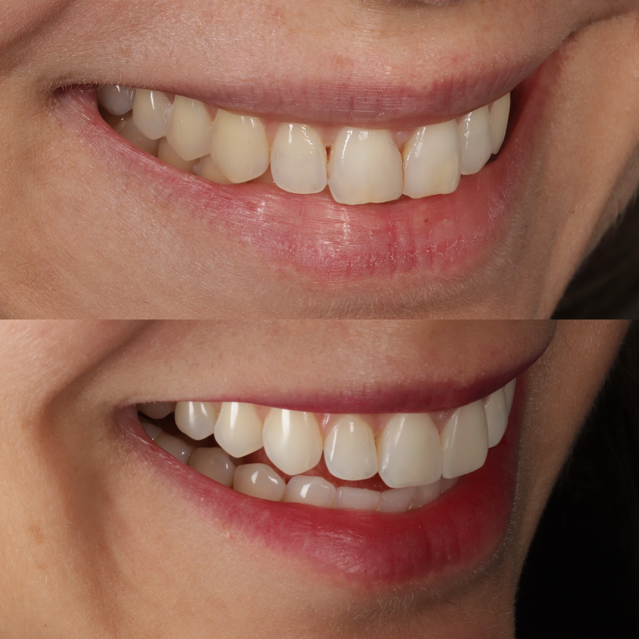 Case 4's Composite Bonding transformation