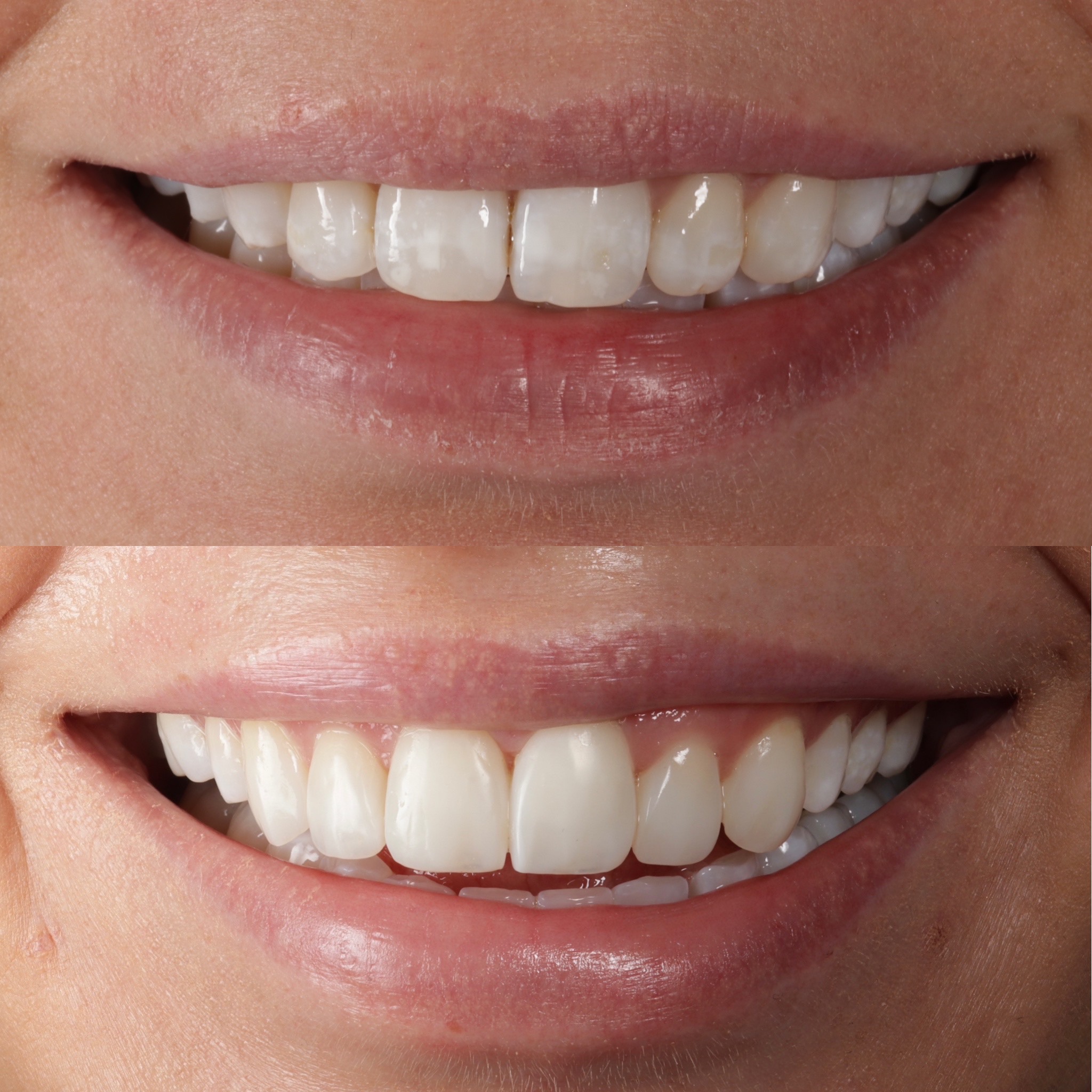 Case 2's Composite Bonding transformation