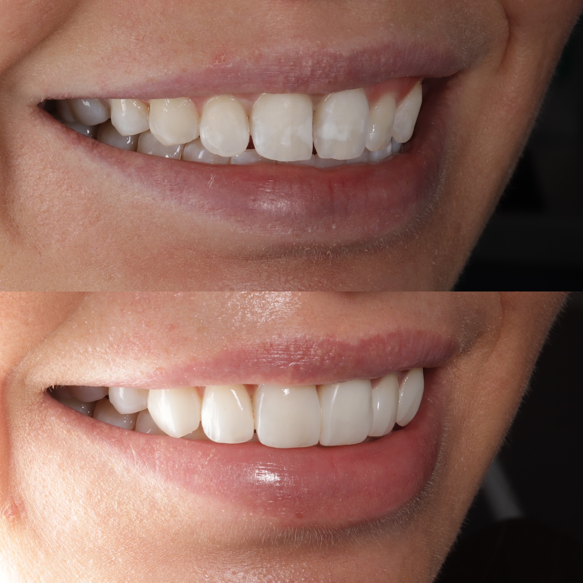 Case 1's Composite Bonding transformation