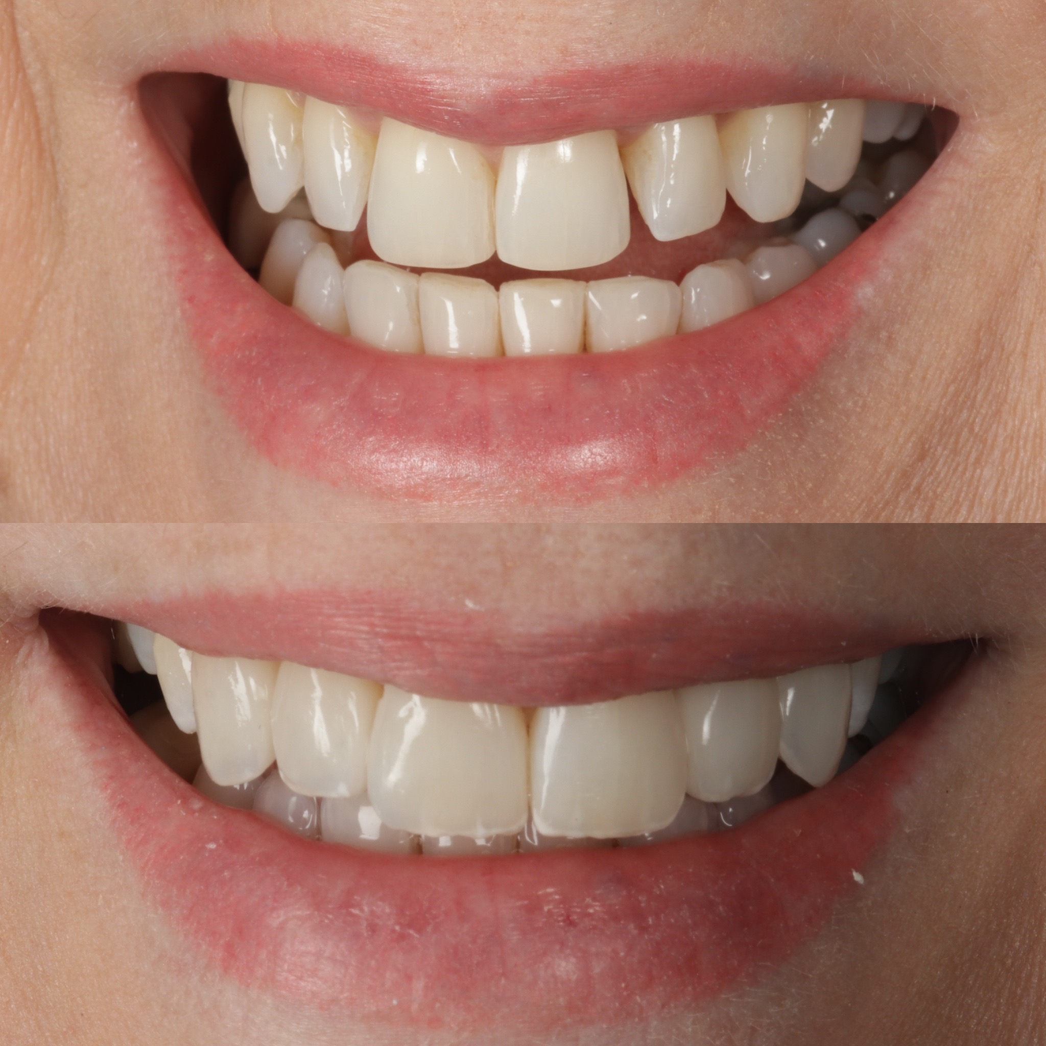 Case 3's Composite Bonding transformation