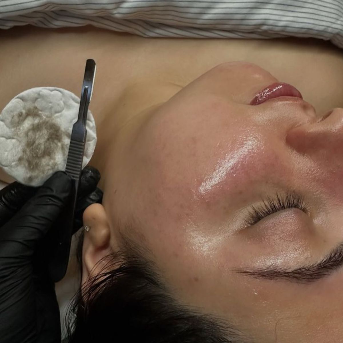 dermaplaning Sussex WI dermaplaning Sussex WI