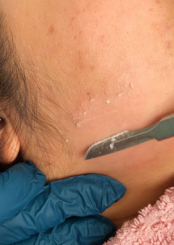 Dermaplaning Aftercare Dermaplaning Aftercare