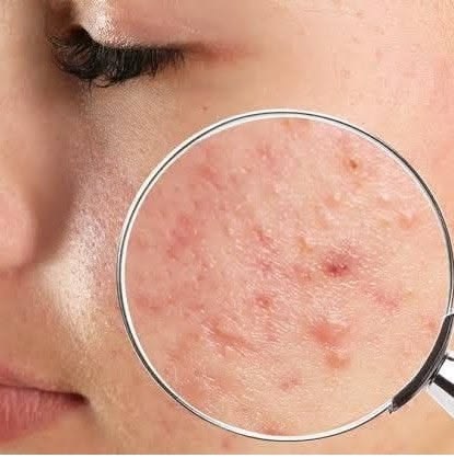 Acne Facial for Congested Skin Acne Facial for Congested Skin