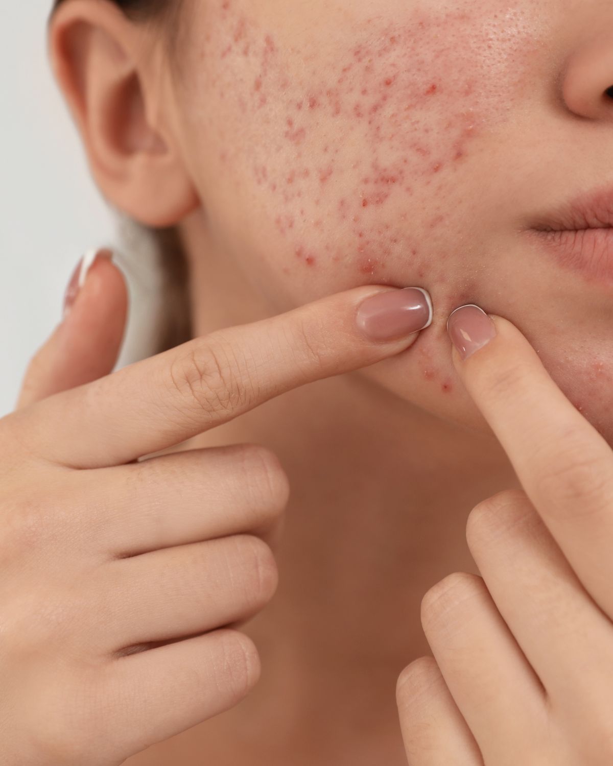 Acne Facial for Congested Skin Acne Facial for Congested Skin