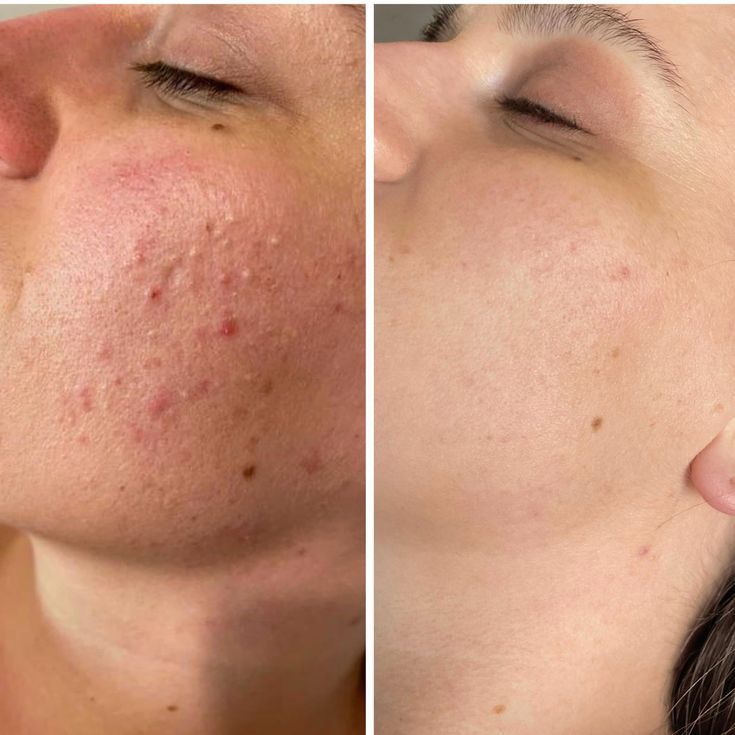 Anti-Aging Facial vs Hydrating Facial Anti-Aging Facial vs Hydrating Facial